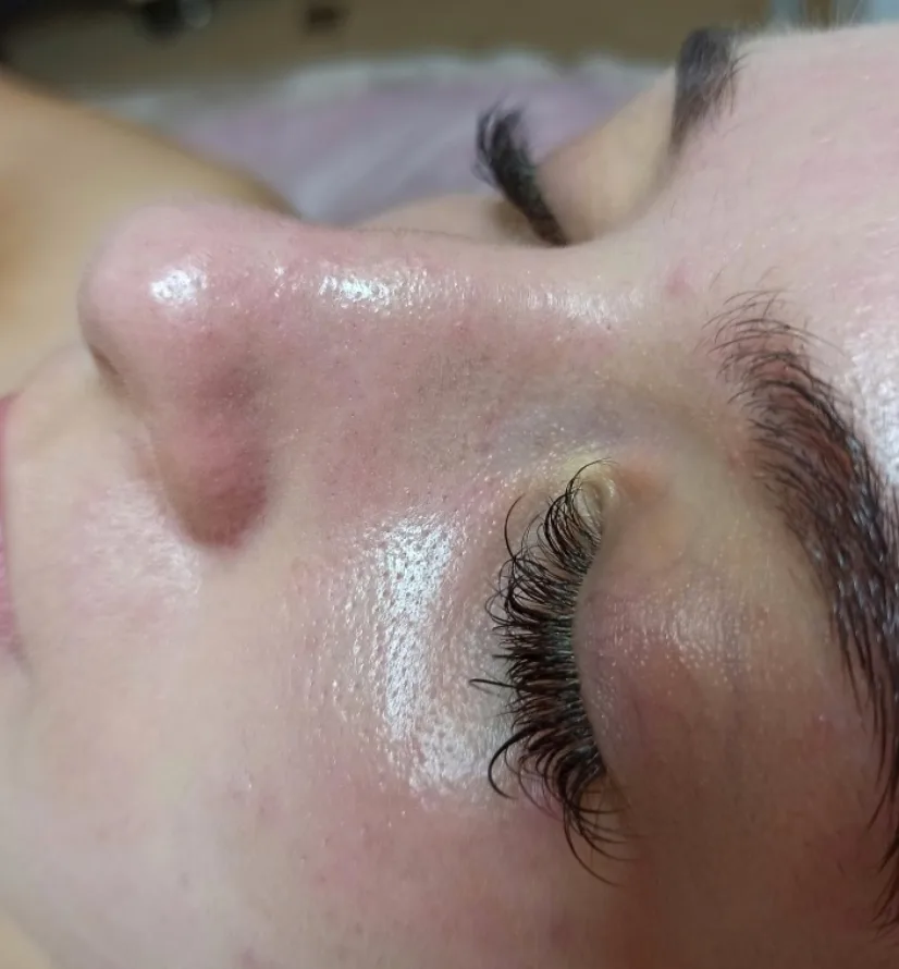 След HydraFacial — чиста и матирана кожа