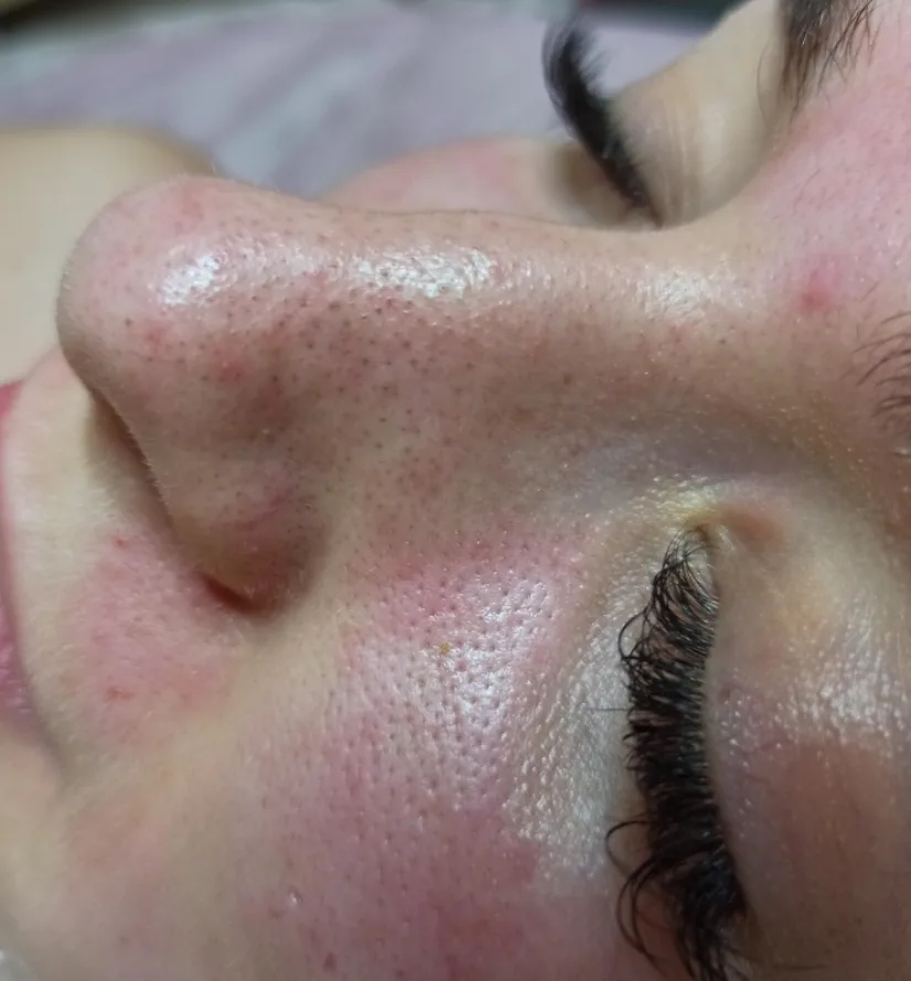 Преди HydraFacial — разширени пори и черни точки