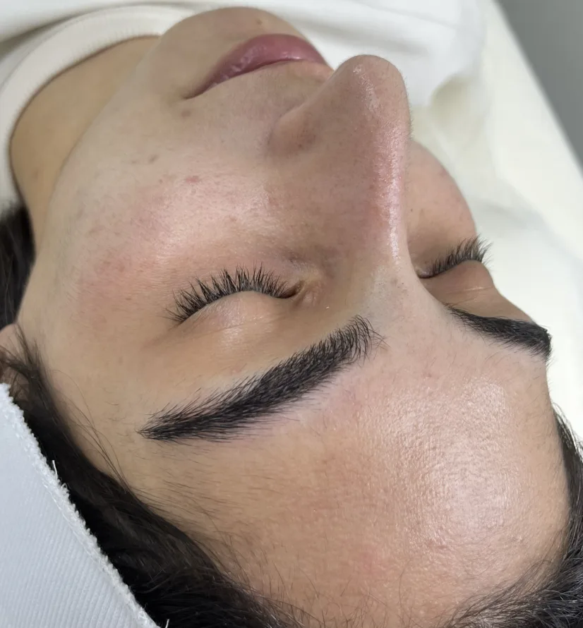 След HydraFacial — сияйна кожа