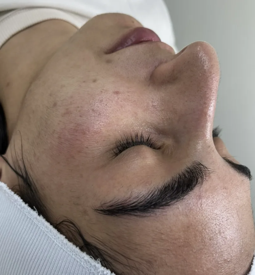 Преди HydraFacial — неравен тен